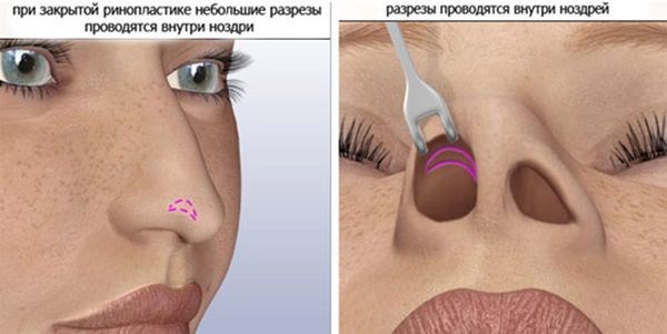 Méthodes de correction des cicatrices chéloïdes après rhinoplastie