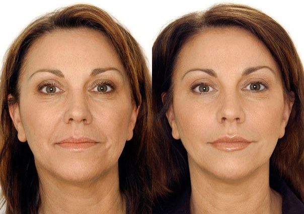 Biorévitalisation du visage. Techniques, étapes du cours, caractéristiques de la procédure