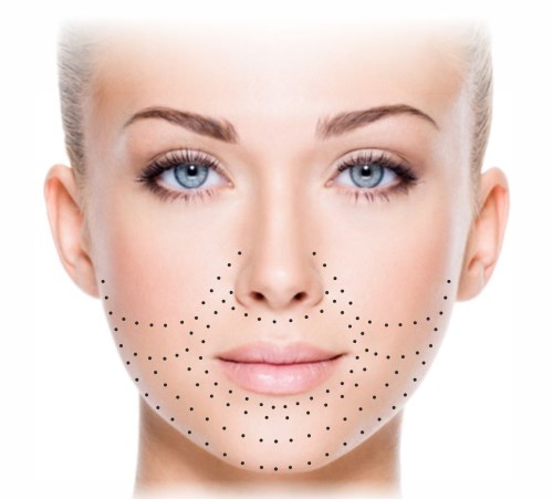 Biorévitalisation du visage. Techniques, étapes du cours, caractéristiques de la procédure