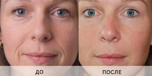 Biorévitalisation du visage. Techniques, étapes du cours, caractéristiques de la procédure