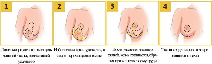 Chirurgie de réduction mammaire. Photos, vidéos, prix, avis