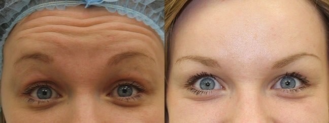 Relatox ou Botox - quel est le meilleur? Comparaison des injections de beauté