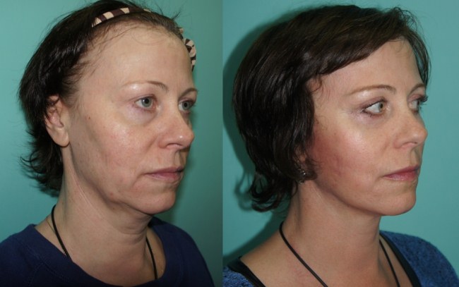 Injections d'acide hyaluronique pour le visage (lèvres, sous les yeux, front). Photos avant et après