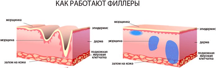 Injections d'acide hyaluronique pour le visage (lèvres, sous les yeux, front). Photos avant et après