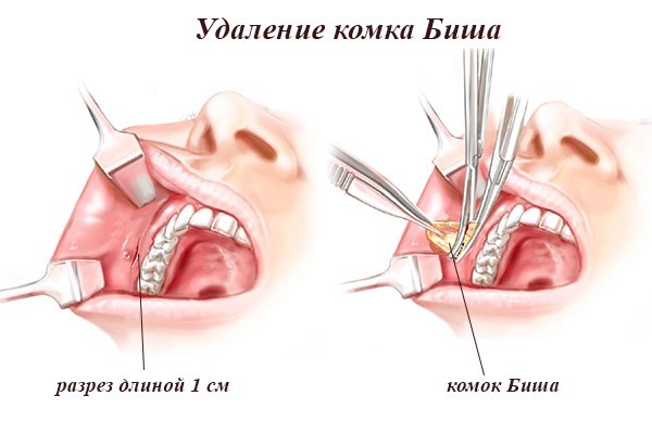 Morceaux de Bisha. Qu'est-ce que c'est, comment est-il enlevé, l'opération, comment le nettoyer à la maison