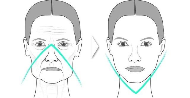 Contour du visage - qu'est-ce que c'est, étapes, caractéristiques, résultats de la procédure