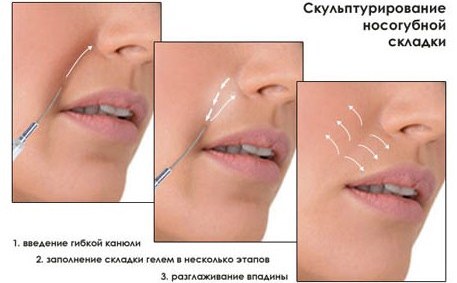 Contour du visage - qu'est-ce que c'est, étapes, caractéristiques, résultats de la procédure