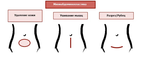 Abdominoplastie (abdominoplastie). Qu'est-ce que c'est, prix, photos avant et après, vidéo, critiques