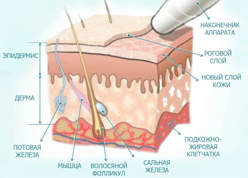 Peeling au diamant pour la peau du visage. Qu'est-ce que c'est, indications, appareil, prix de la procédure, photo