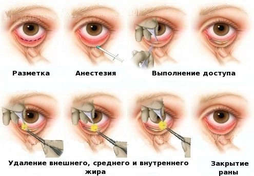 Blépharoplastie - qu'est-ce que c'est, comment ça se passe, photos avant et après