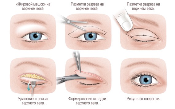 Blépharoplastie - qu'est-ce que c'est, comment ça se passe, photos avant et après