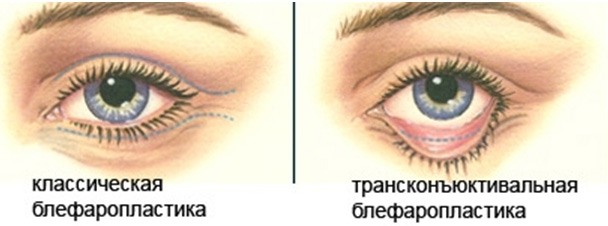 Blépharoplastie - qu'est-ce que c'est, comment ça se passe, photos avant et après