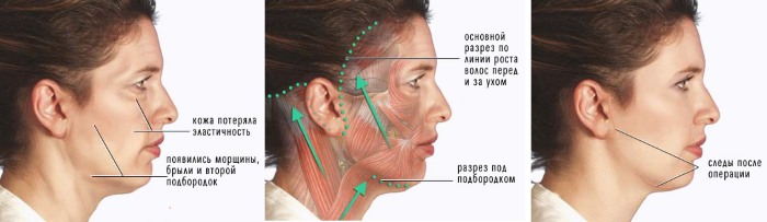 Facelift pour le visage - exercices, chirurgie, lifting