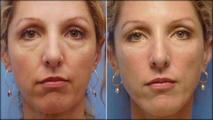 Facelift pour le visage - exercices, chirurgie, lifting