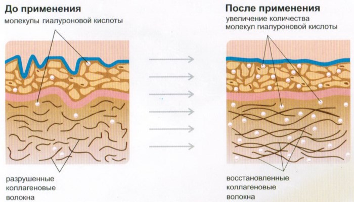 Remplisseurs pour le visage. Qu'est-ce que c'est en cosmétologie, ce qui est mieux, des photos avant, après la procédure