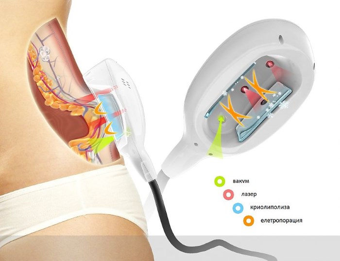 Cryolipolyse (cryoliposuccion). Qu'est-ce que c'est, prix, avis