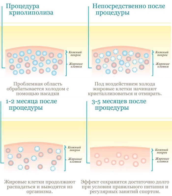 Cryolipolyse (cryoliposuccion). Qu'est-ce que c'est, prix, avis