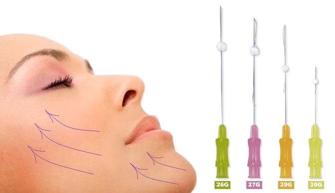 Lifting du visage - quelle est cette procédure. RF-lifting, fils faciaux, levage non chirurgical