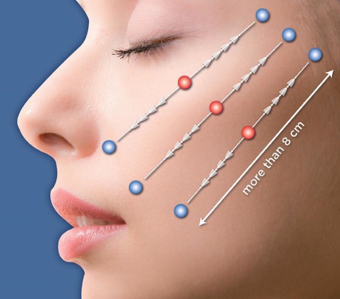 Lifting du visage - quelle est cette procédure. RF-lifting, fils faciaux, levage non chirurgical