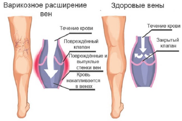 Massage de drainage lymphatique. Quelle est cette procédure pour perdre du poids, du matériel, des massages à domicile. Photo, vidéo