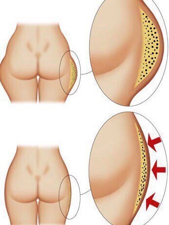 Enveloppement au miel minceur de la cellulite à la maison. Recettes, avis