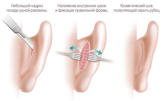 Comment se déroule l'otoplastie