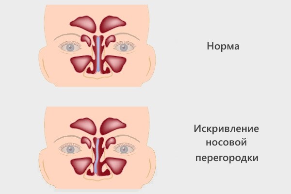 Septoplastie. Qu'est-ce que c'est, chirurgie de la cloison nasale, laser, indications