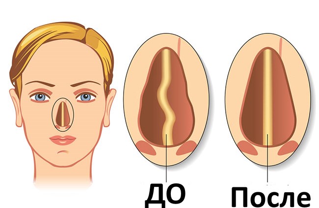 Septoplastie. Qu'est-ce que c'est, chirurgie de la cloison nasale, laser, indications