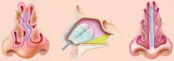 Septoplastie. Qu'est-ce que c'est, chirurgie de la cloison nasale, laser, indications