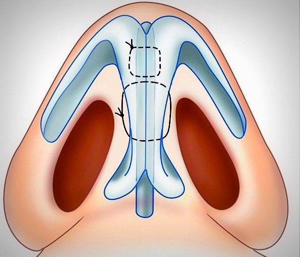 Septoplastie. Qu'est-ce que c'est, chirurgie de la cloison nasale, laser, indications