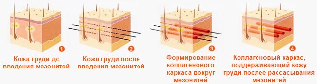 Le coût des chirurgies de lifting et de correction des seins. Mammoplastie, levage, serrage