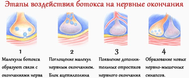 Injections de Botox dans le front. Résultats, photos avant et après, conséquences, avis