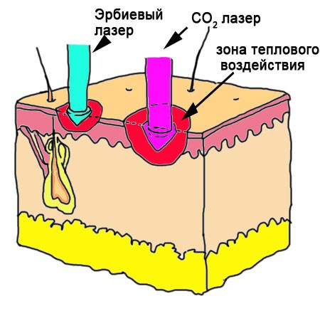 Peeling chimique pour le visage. Qu'est-ce que c'est, comment le faire à la maison, recettes, photos