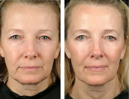 Benang emas untuk facelift. Apakah prosedur ini, foto, video, harga, ulasan