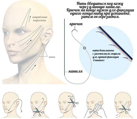 Benang emas untuk facelift. Apakah prosedur ini, foto, video, harga, ulasan