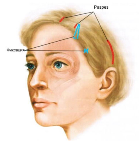 Qu'est-ce qu'un lifting endoscopique