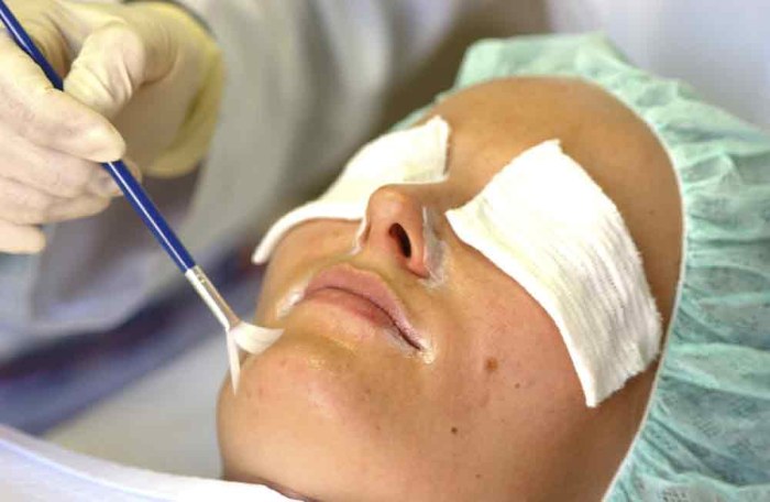 Qu'est-ce qu'un peeling chimique pour le visage