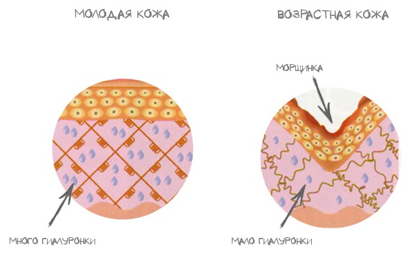 Acide hyaluronique - qu'est-ce que c'est, composition, avantages et inconvénients, propriétés. Avis de médecins, cosmétologues