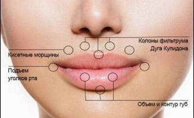 Contour des lèvres - une technique d'augmentation avec de l'acide hyaluronique, des charges. Photos et tarifs