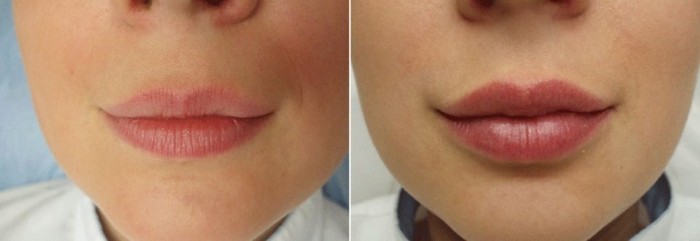 Contour des lèvres - une technique d'augmentation avec de l'acide hyaluronique, des charges. Photos et tarifs