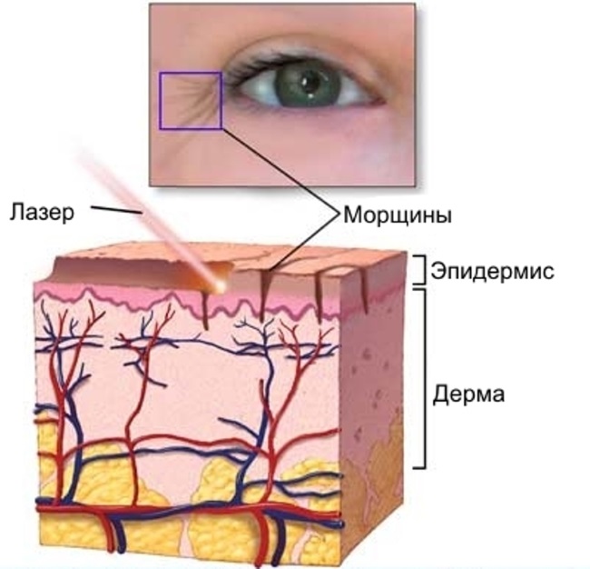 Resurfaçage au laser de la peau du visage à partir de cicatrices et de cicatrices. Photos avant et après, prix, avis. Soins de la peau à domicile après la procédure