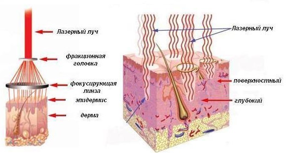 Resurfaçage au laser de la peau du visage à partir de cicatrices et de cicatrices. Photos avant et après, prix, avis. Soins de la peau à domicile après la procédure