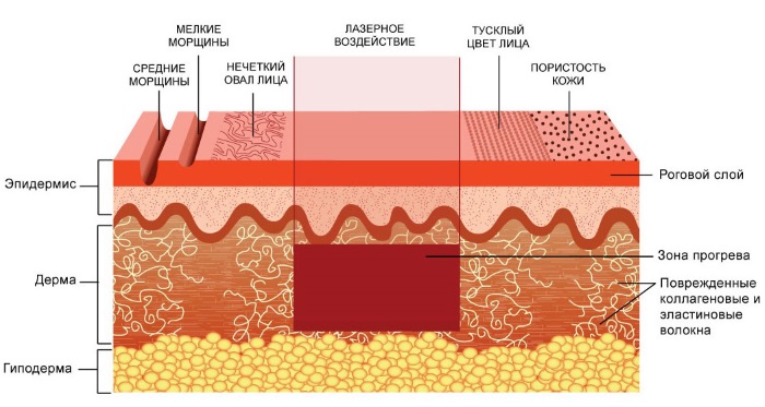 Resurfaçage au laser de la peau du visage à partir de cicatrices et de cicatrices. Photos avant et après, prix, avis. Soins de la peau à domicile après la procédure