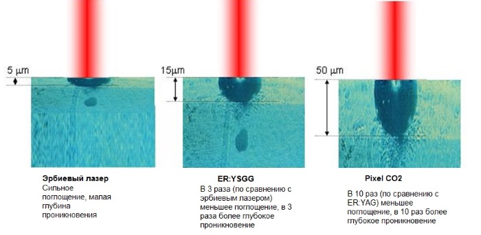 Resurfaçage au laser de la peau du visage à partir de cicatrices et de cicatrices. Photos avant et après, prix, avis. Soins de la peau à domicile après la procédure