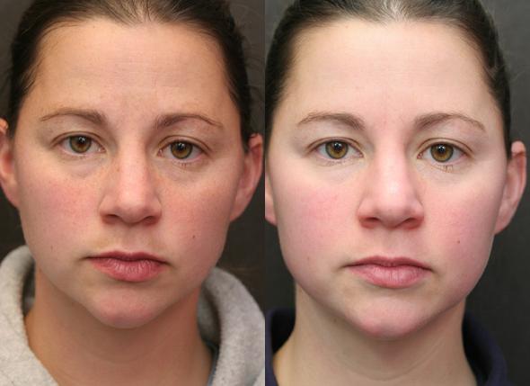 Resurfaçage au laser de la peau du visage à partir de cicatrices et de cicatrices. Photos avant et après, prix, avis. Soins de la peau à domicile après la procédure