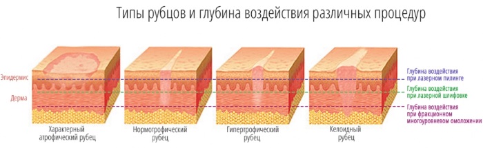 Resurfaçage au laser de la peau du visage à partir de cicatrices et de cicatrices. Photos avant et après, prix, avis. Soins de la peau à domicile après la procédure