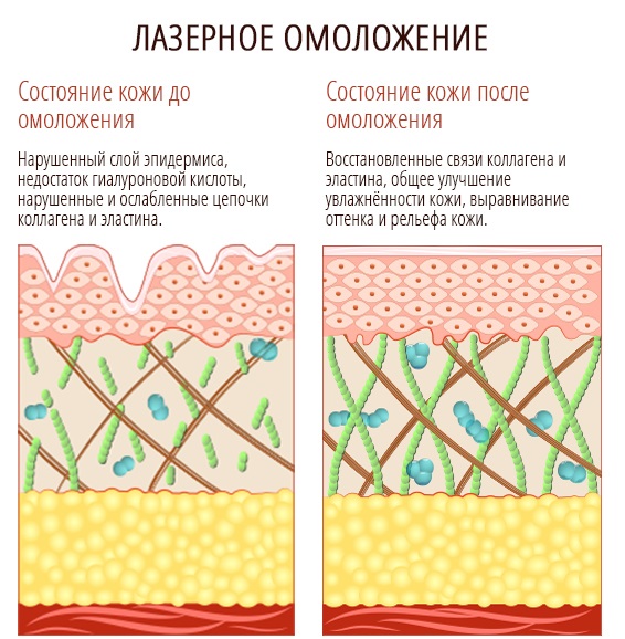 Resurfaçage au laser de la peau du visage à partir de cicatrices et de cicatrices. Photos avant et après, prix, avis. Soins de la peau à domicile après la procédure