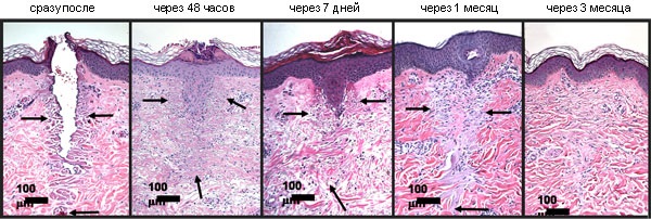 Resurfaçage au laser de la peau du visage à partir de cicatrices et de cicatrices. Photos avant et après, prix, avis. Soins de la peau à domicile après la procédure