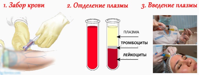 Thérapie plasma - Plasmolifting de la peau du visage et du cou, indications, contre-indications, photos, prix de la procédure, avis