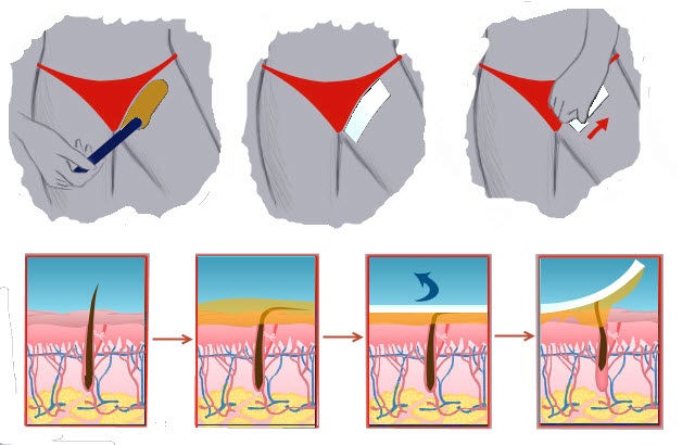 Bandes d'épilation. Comment utiliser pour le visage, la zone du bikini. Ce qui est mieux: cire, Veet. Commentaires
